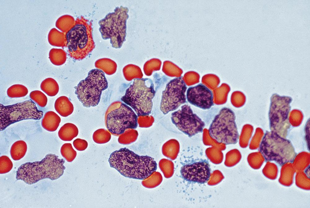 La leucémie lymphoblastique aigüe (ALL) de l'adulte