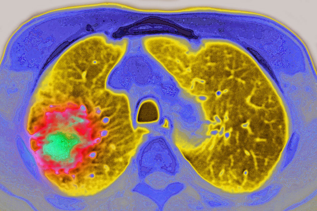 Een beter inzicht in de pathogenese van longkanker
