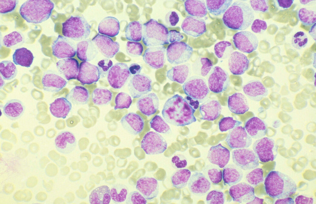 Quizartinib goed alternatief bij recidief FLT3-ITD acute myeloïde leukemie
