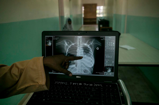 Action Damien pour un meilleur accès aux soins des patients atteints de tuberculose