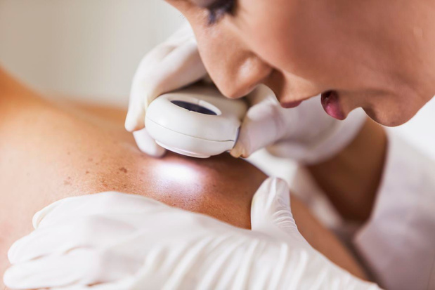 Meer screening op huidkanker, maar wachtlijsten bij dermatoloog zijn probleem