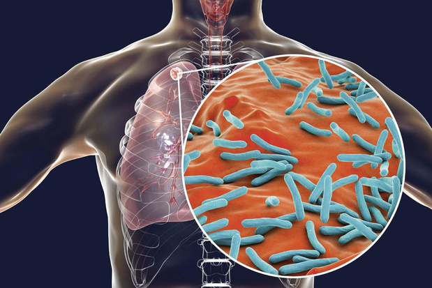 Negatief effect pandemie op tuberculose 