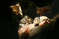 Succès pour la première transplantation d'un rein de porc sur l'homme