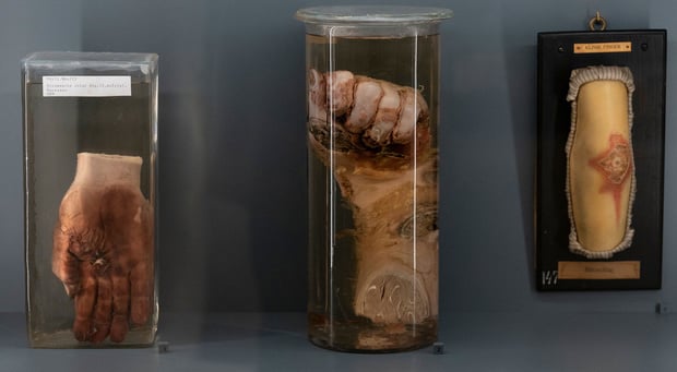 Le Museum d'Histoire naturelle de Vienne expose les corps malades, en évitant le voyeurisme