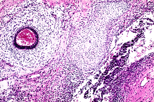 Présence de tératome et décès lié à la maladie dans les tumeurs à cellules germinales avancées