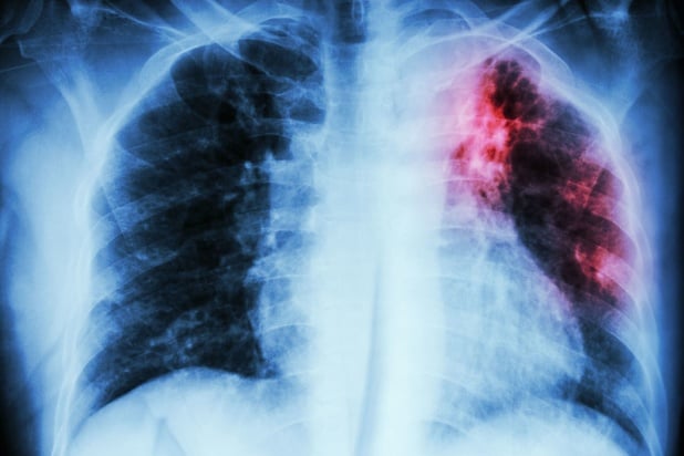 La tuberculose ultrarésistante, un nouveau fléau difficile à éradiquer