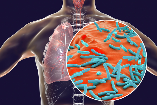 Negatief effect covid-19-pandemie op tuberculose