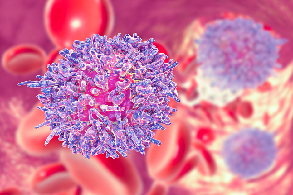 Association de vemurafenib et de rituximab : un espoir dans la leucémie à tricholeucocytes ?
