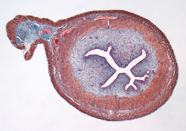 Cancer du col de l'utérus à l'ESMO 2021