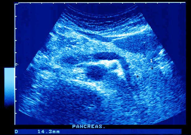 Pancreascysten: nut virtuele biopsie met beeldvormingsonderzoek