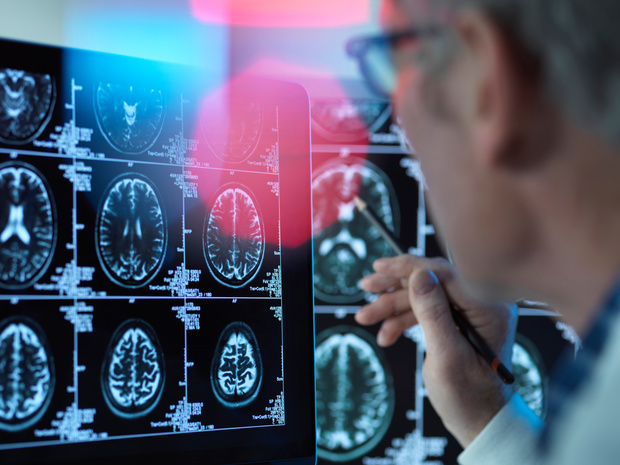 Un nouveau scanner permet de détecter la maladie d'Alzheimer à un stade précoce