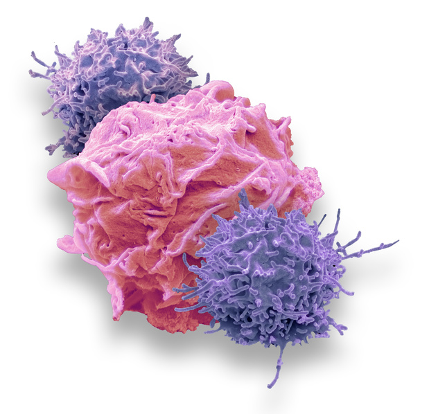 EMA goedkeuring voor lisocabtagene maraleucel bij grootcellig B-cellymfoom