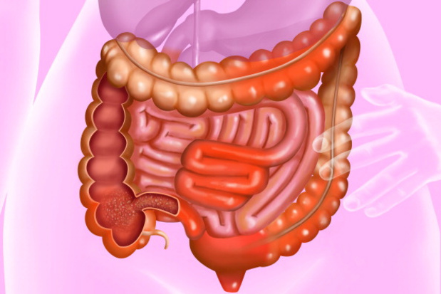 Perianale fistels en ziekte van Crohn