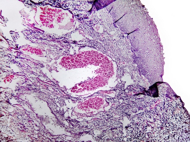 Un lien découvert entre le microbiome et le cancer du col utérin