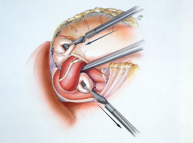 Welke chirurgische procedure bij gastro-oesofageale reflux?
