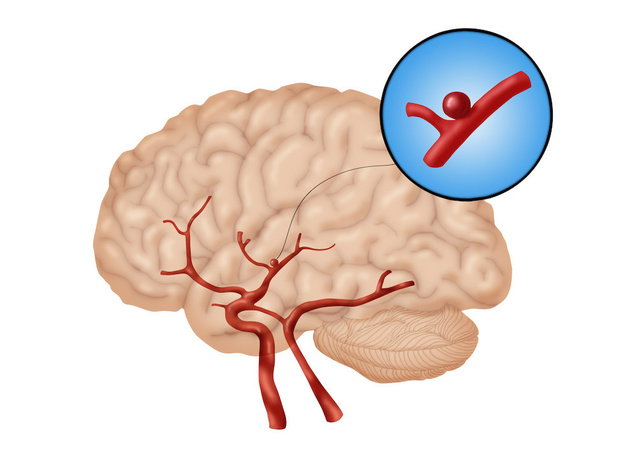 Maladie des petits vaisseaux cérébraux: les antirétroviraux plaident non coupables