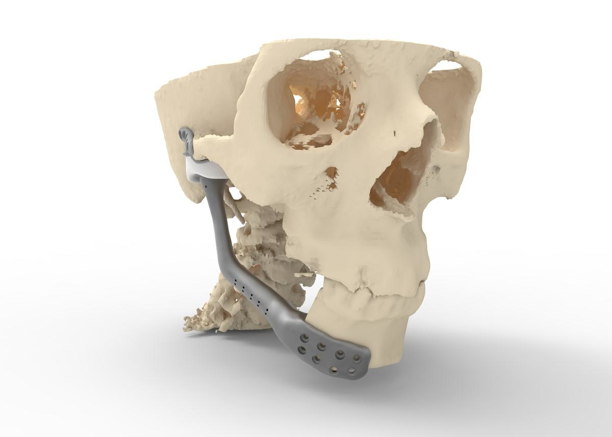 La prothèse en version étendue pour remplacer une partie de la mandibule., Cadskills