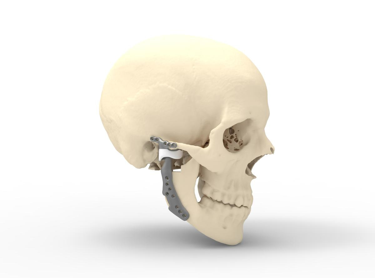 La prothèse articulaire temporo-mandibulaire est modélisée en titane 3D en fonction de la pathologie., Cadskills